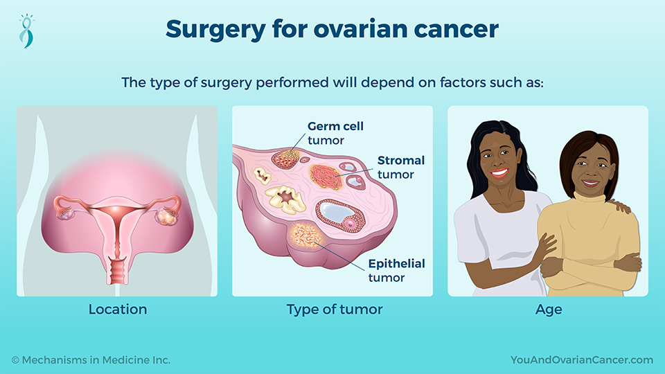 ovarian cancer tumor